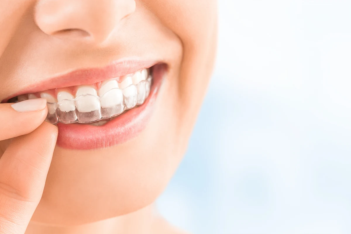 Invisalign – nevidljivi ortodontski aparat