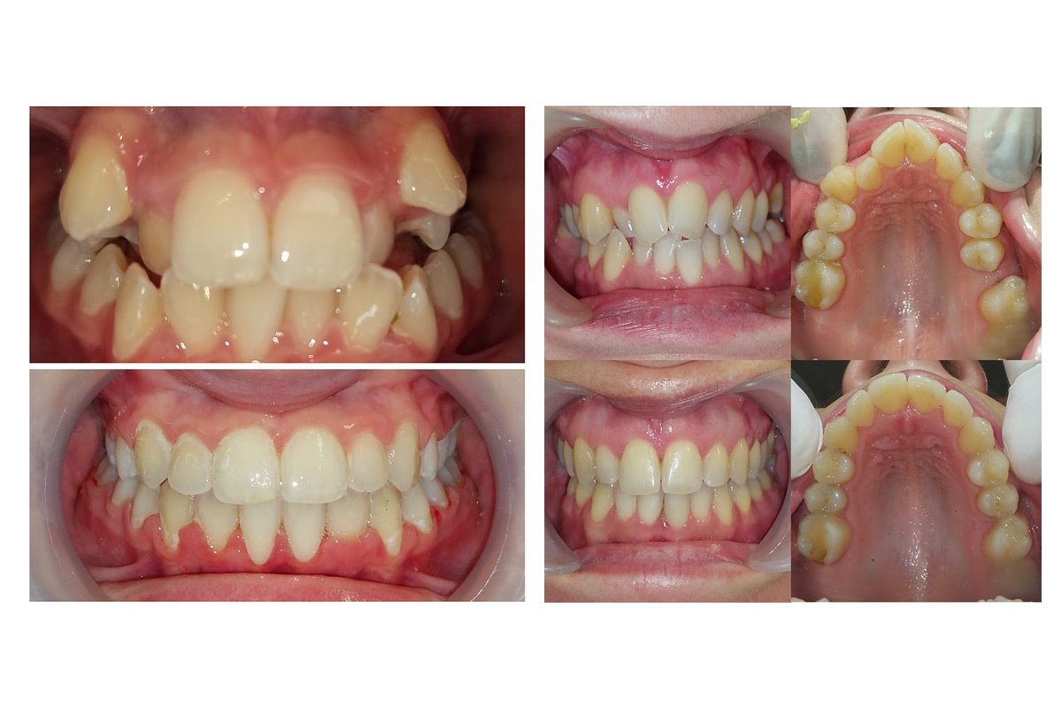 Fiksna ortodonska terapija - prikaz slučaja