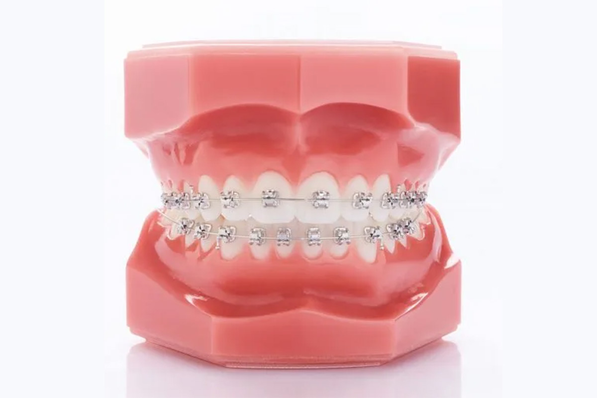 Fiksna ortodonska terapija