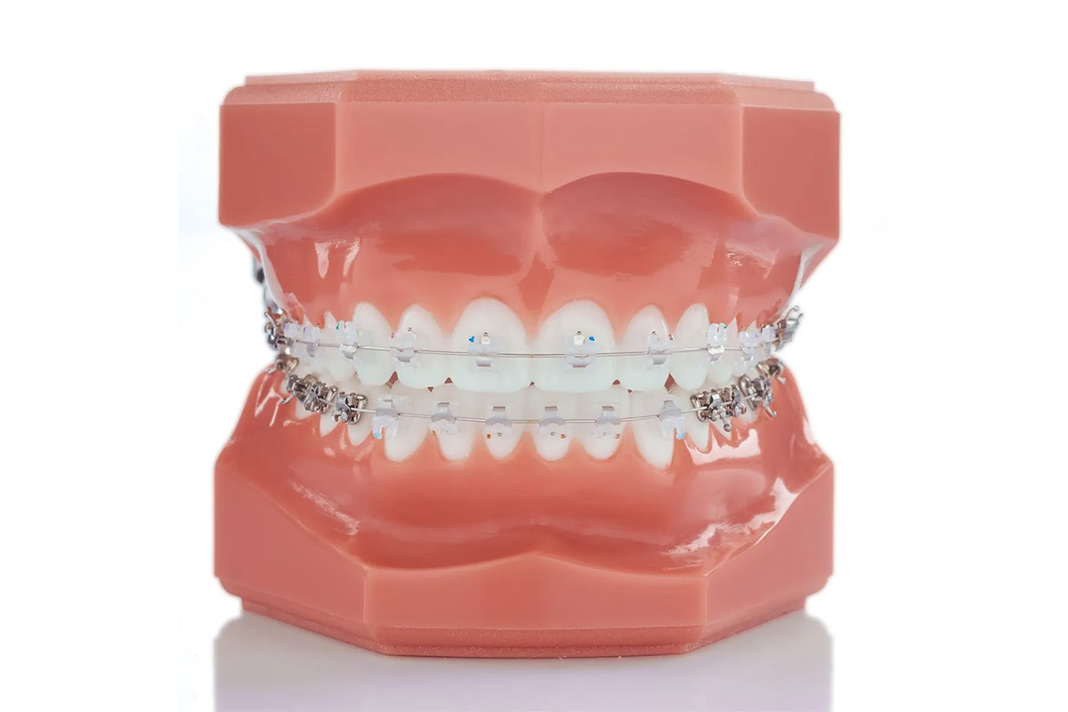 Fiksna ortodonska terapija
